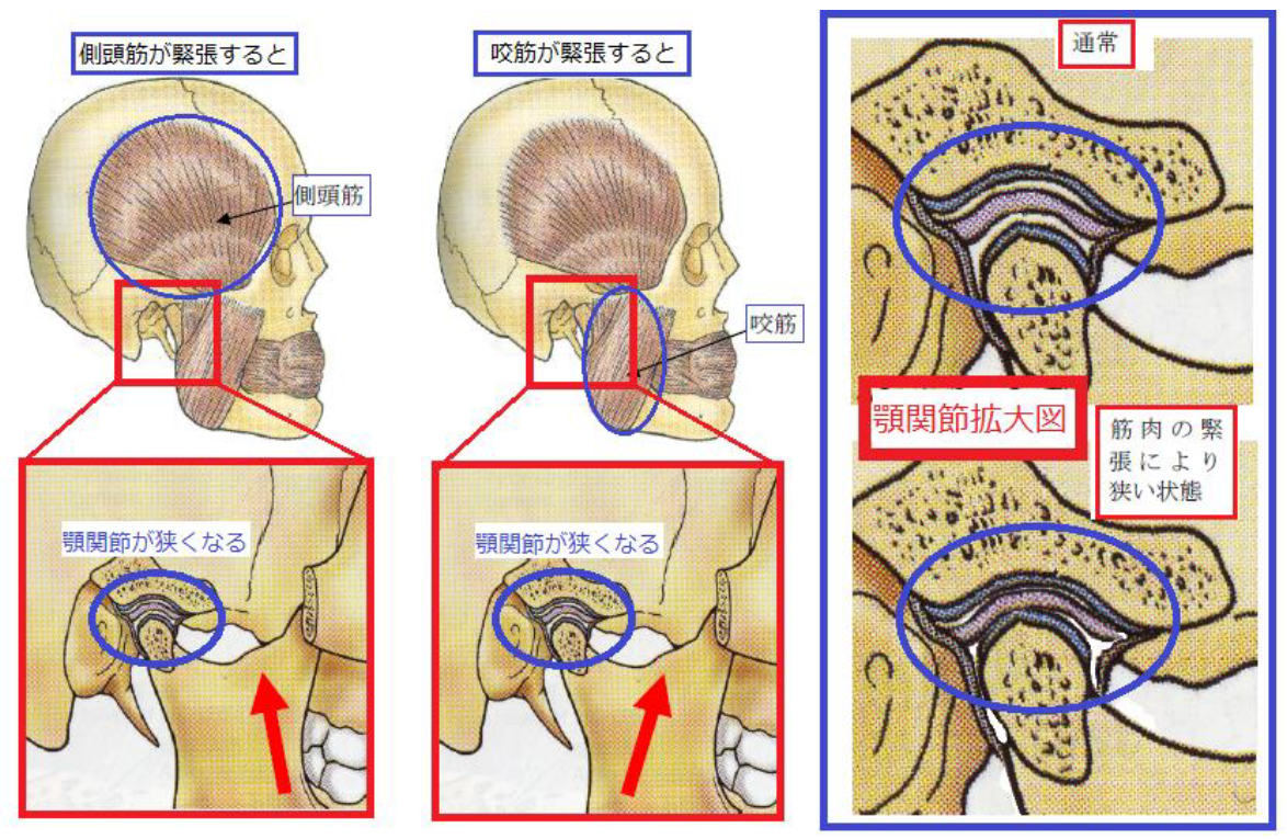 顔 の 歪み 顎 関節 症